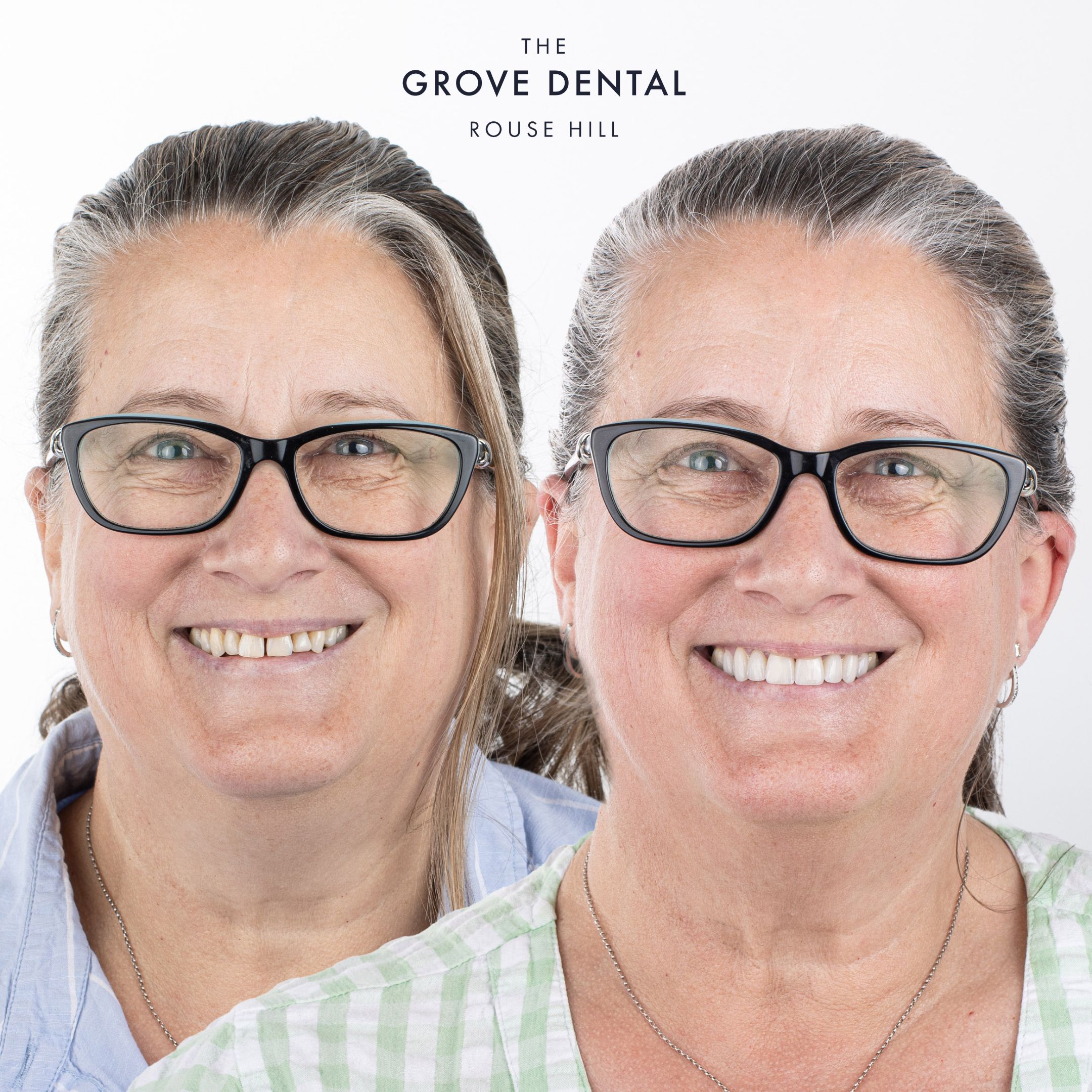 rouse hill porcelain veneers