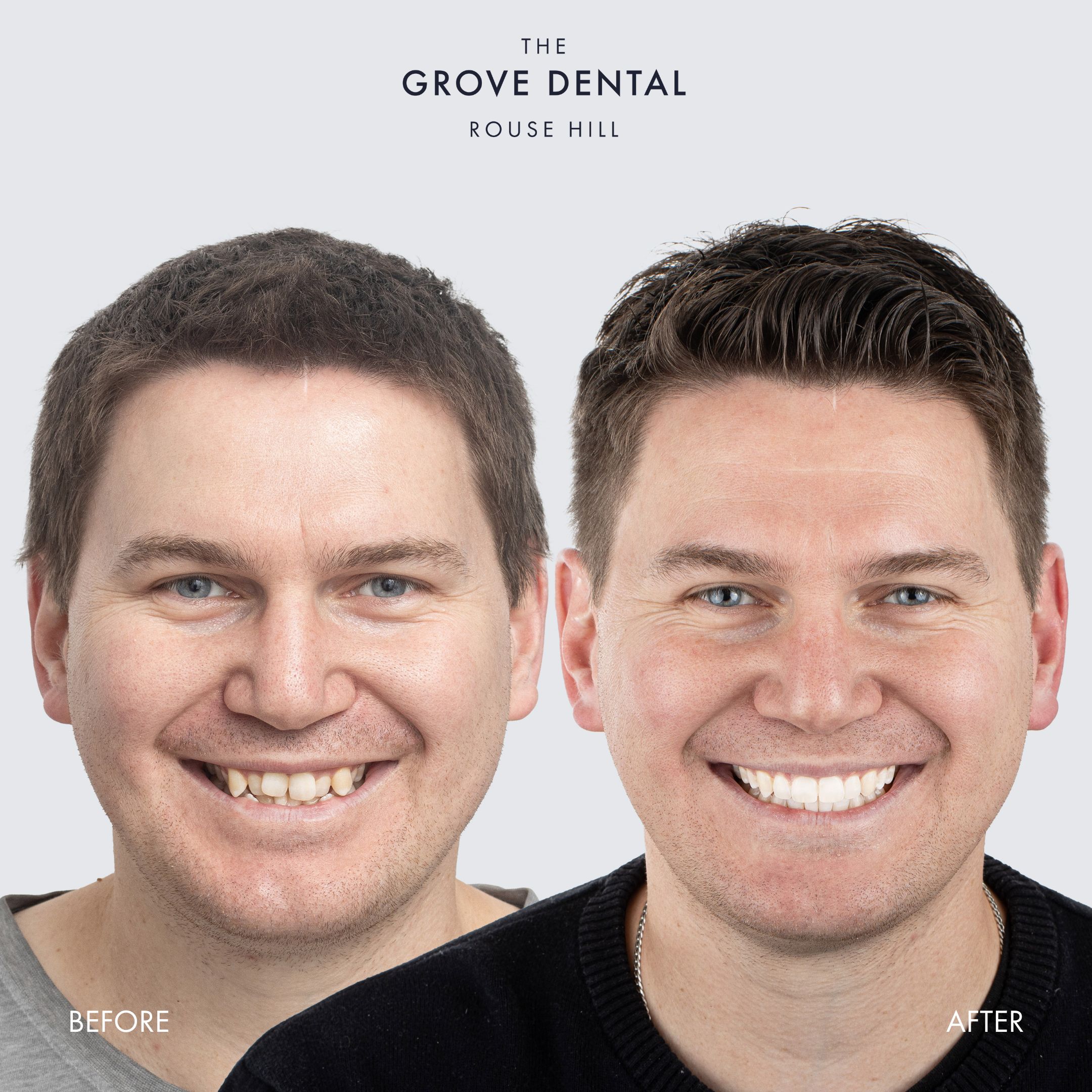 clear aligners sydney