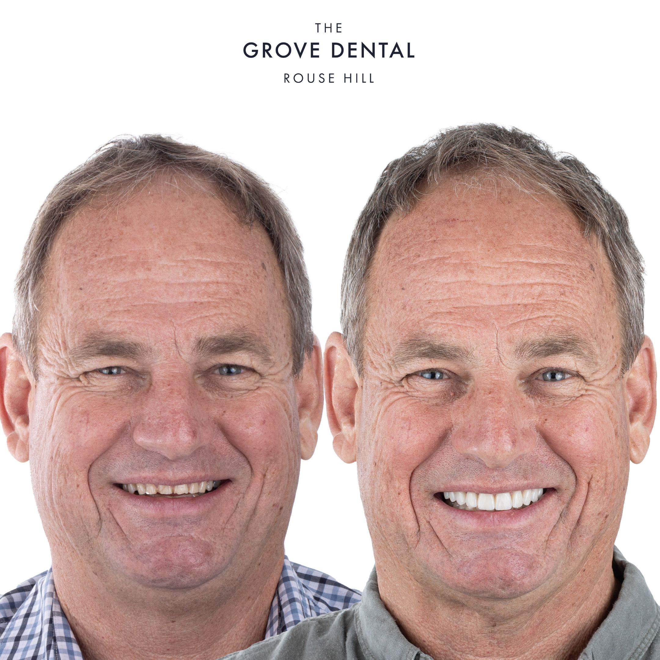 smile makeover veneers sydney